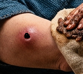 Image of King Hezekiah's Anthrax boil. (C) Born-Again-Christian.Org